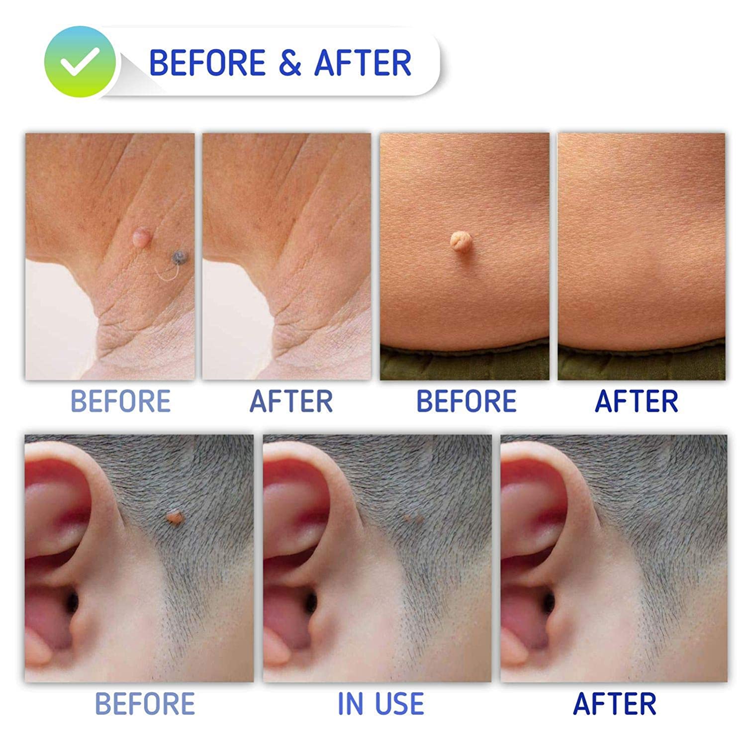 Skin Tag Remover Patches - (108 Pcs) Natural and Frankincense Myrrh Creamy Body 11.5 Ounce and Skin 