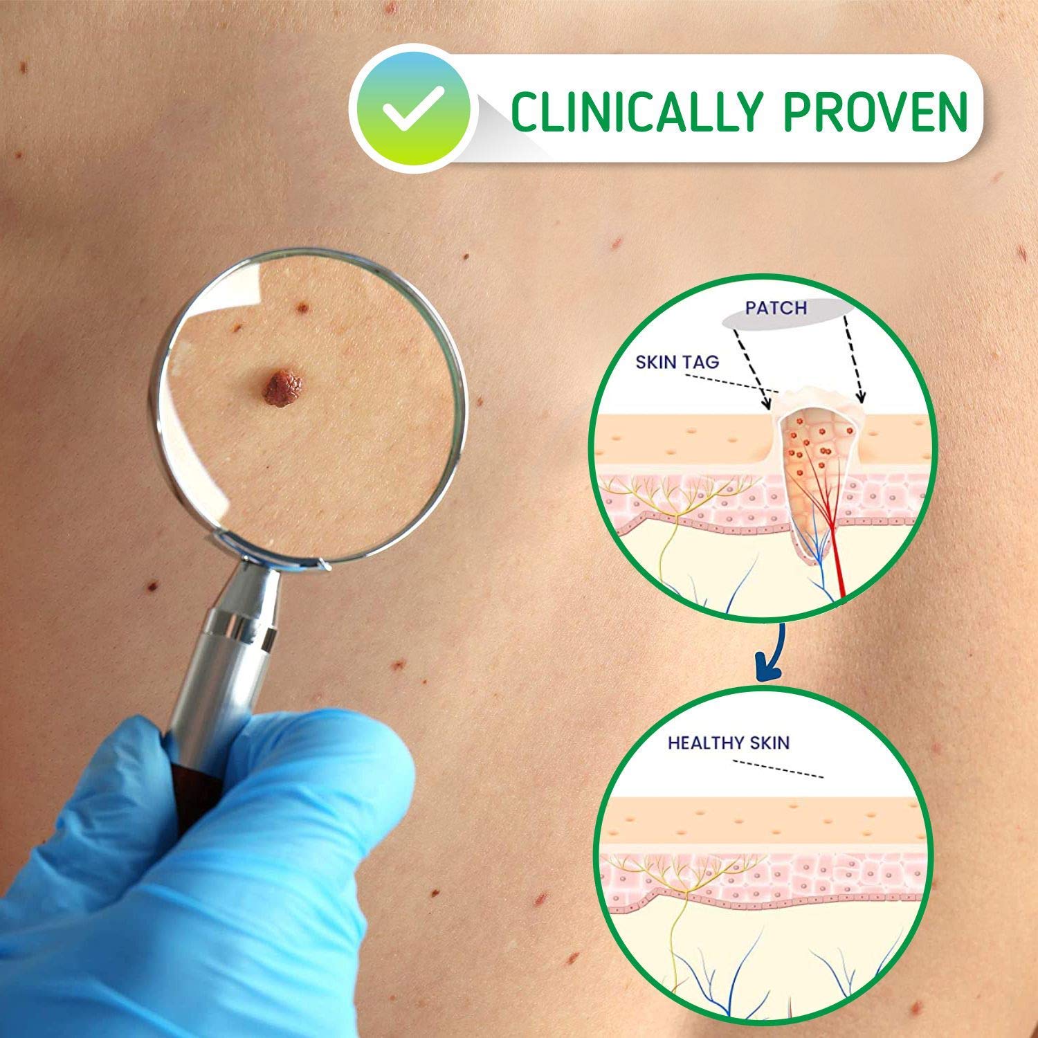 Skin Tag Remover Patches - (108 Pcs) Natural and Frankincense Myrrh Creamy Body 11.5 Ounce and Skin 