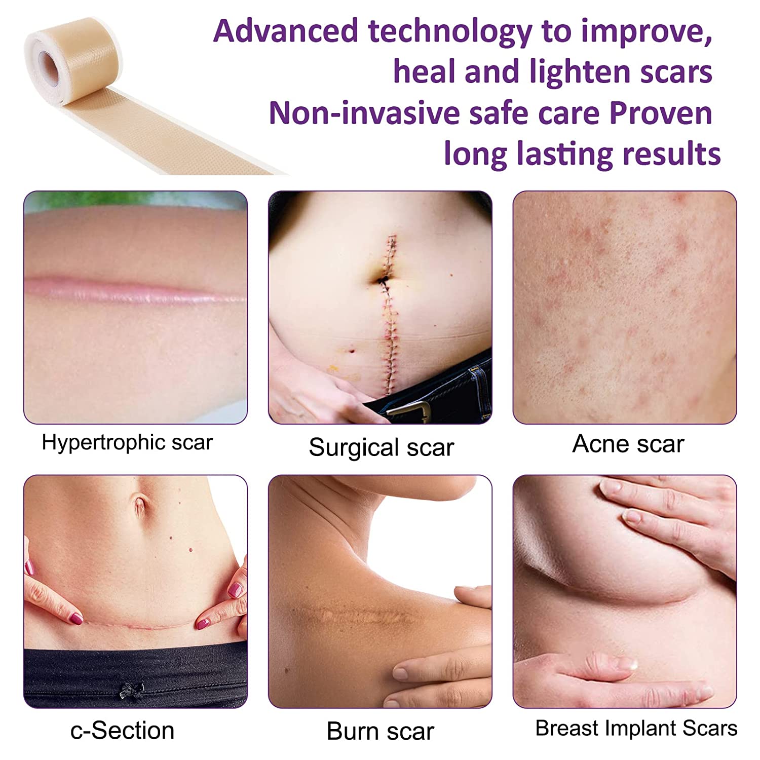 Silicone Scar Sheets, Medical Tape for Scar Painless, Reusable, Easy