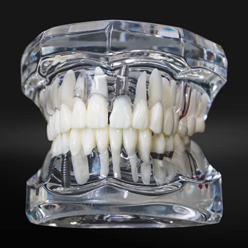 NC Dental Implant Restoration Pathology Bridge Model Teeth Model Teach Study Model 2001C