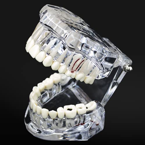 NC Dental Implant Restoration Pathology Bridge Model Teeth Model Teach Study Model 2001C