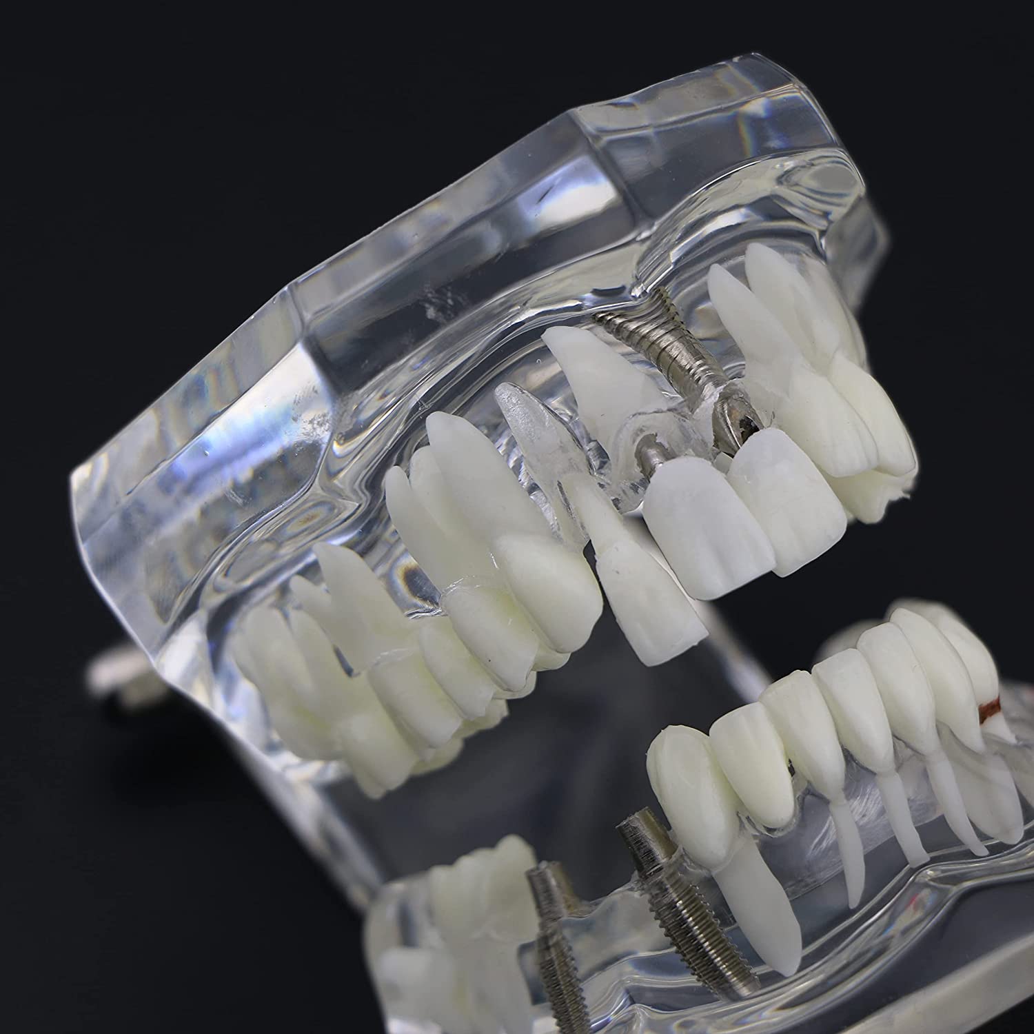 NC Dental Implant Restoration Pathology Bridge Model Teeth Model Teach Study Model 2001C