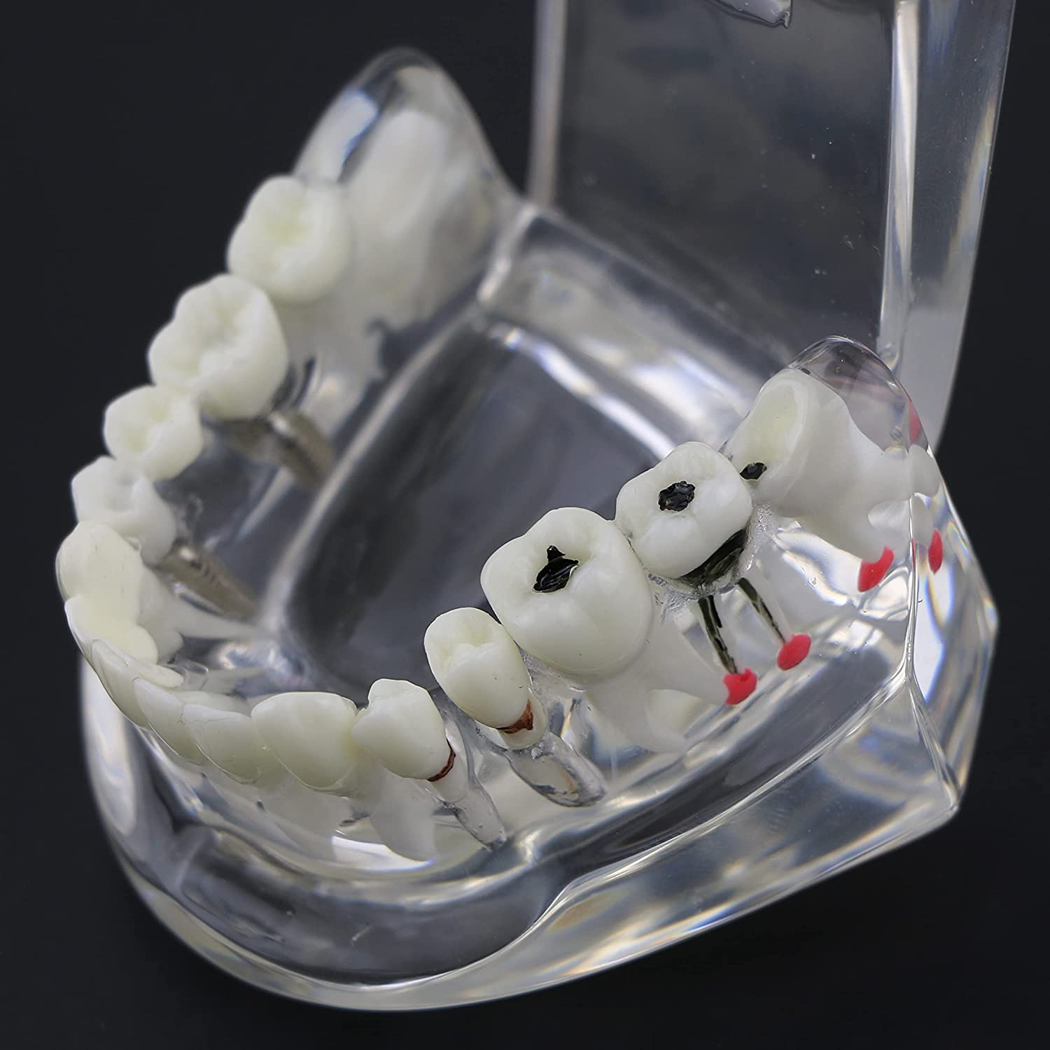 NC Dental Implant Restoration Pathology Bridge Model Teeth Model Teach Study Model 2001C