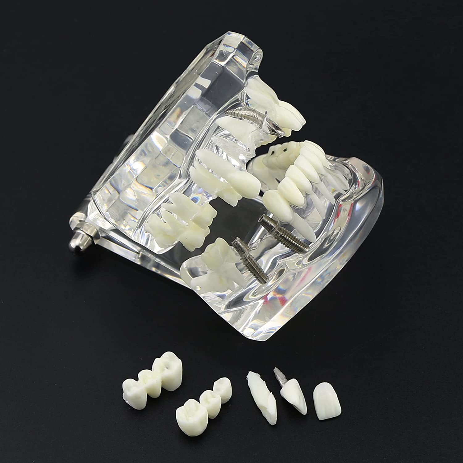 NC Dental Implant Restoration Pathology Bridge Model Teeth Model Teach Study Model 2001C