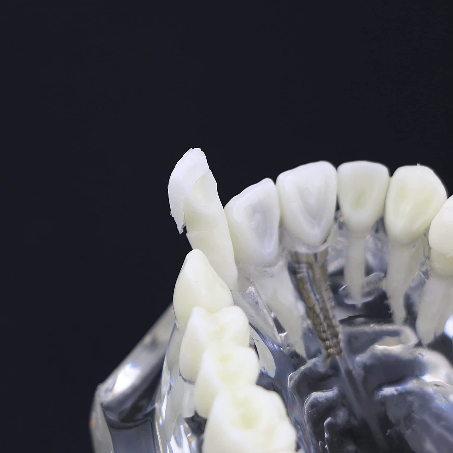 NC Dental Implant Restoration Pathology Bridge Model Teeth Model Teach Study Model 2001C