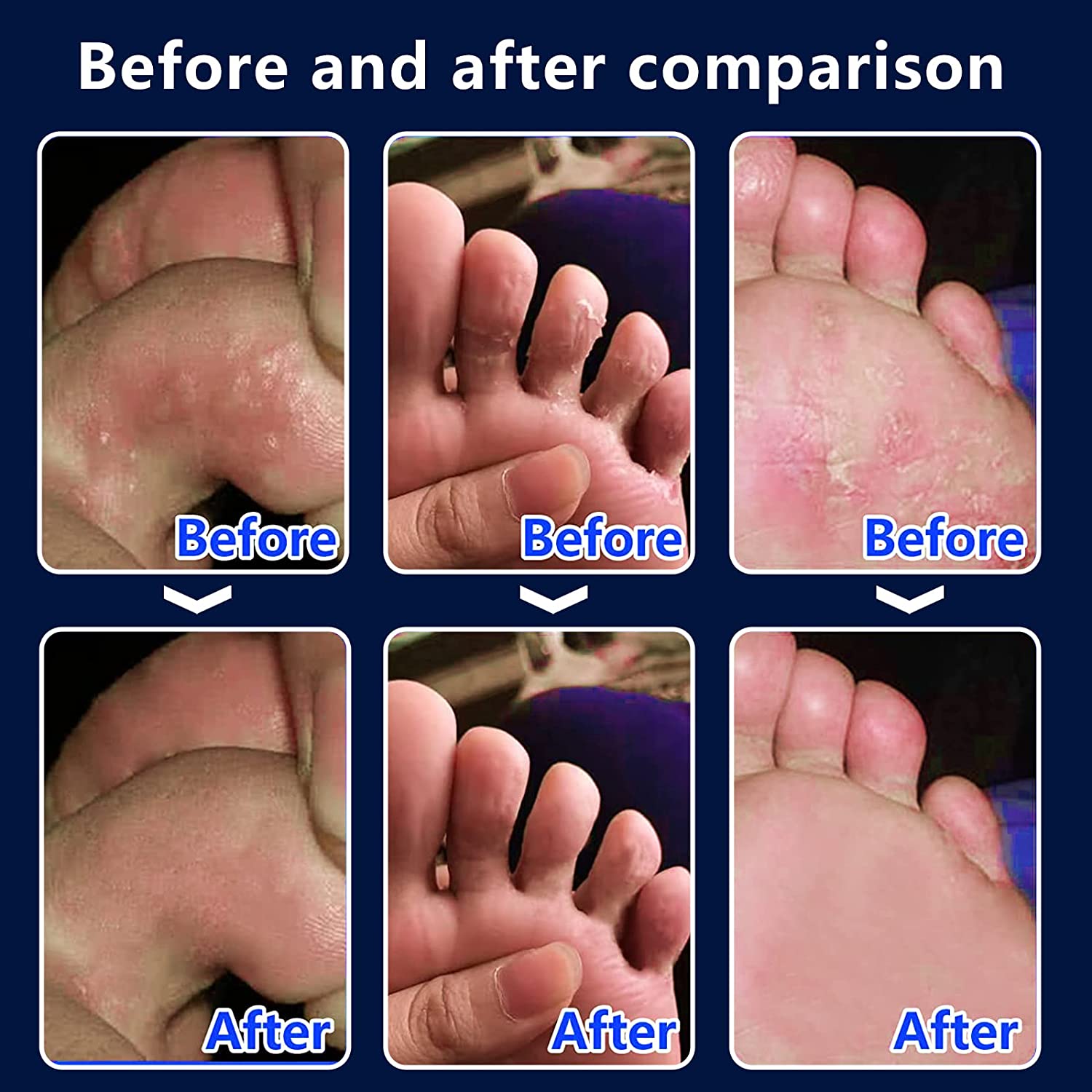 Lanmayee Atheletes Foot Treatment Kit,Athletes Foot Fungi Spray & Antipruritic.Inflamed, Burning,Sme