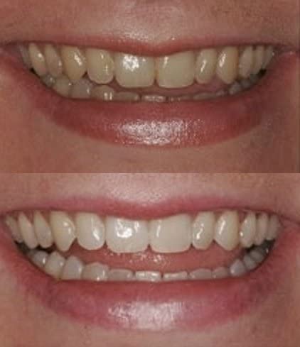 ProDental Teeth Whitening Gel Syringe Refill 10 Pack | 35% Carbamide Peroxide - 60 Treatments | Fast