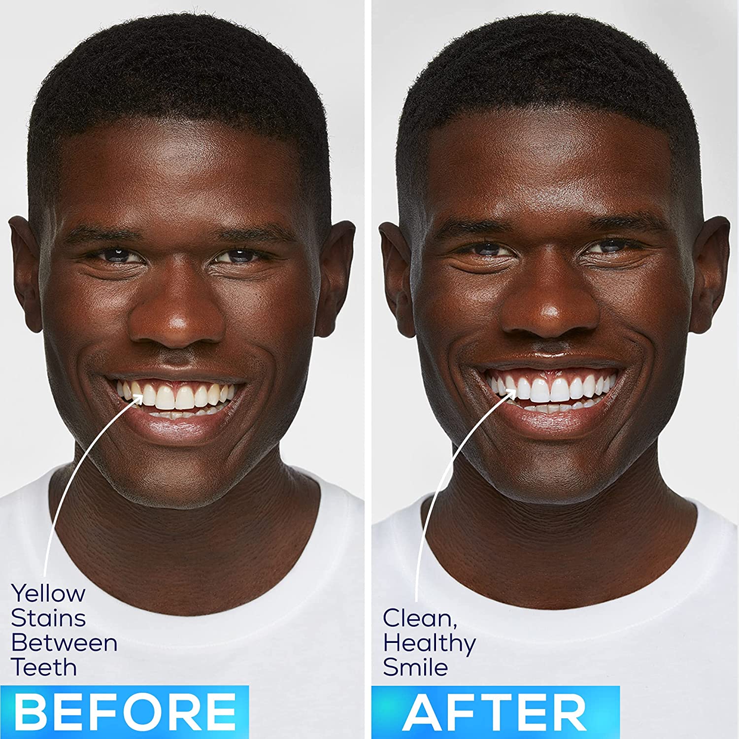 GLO Science GLO Brilliant 3 Pack Teeth Whitening Gel Treatment Kit for Fast, Pain-Free, Long Lasting