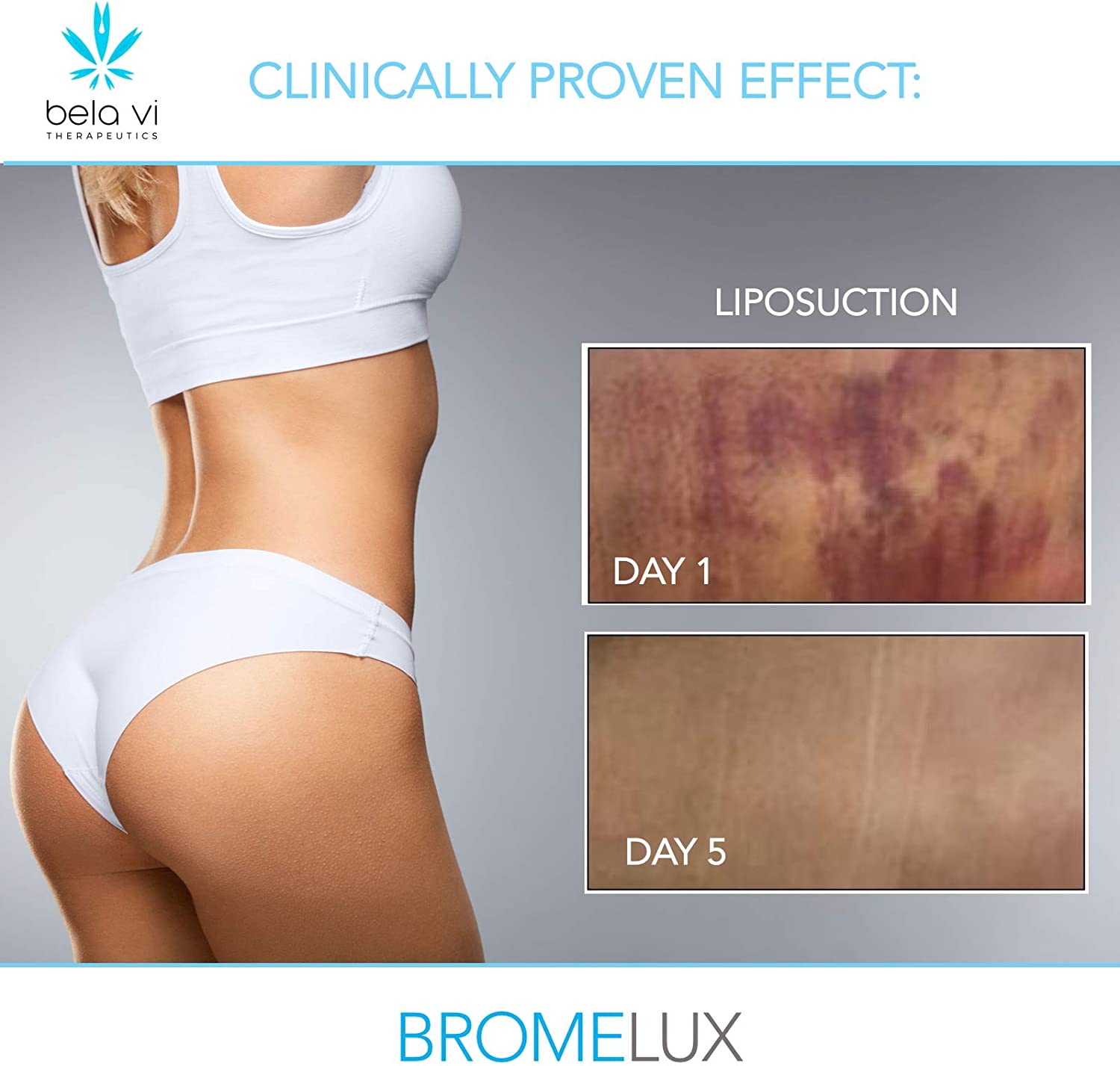 BROMELUX AntiBruising Supplement I Bromelain & Quercetin Complex Swelling & Bruise Relief