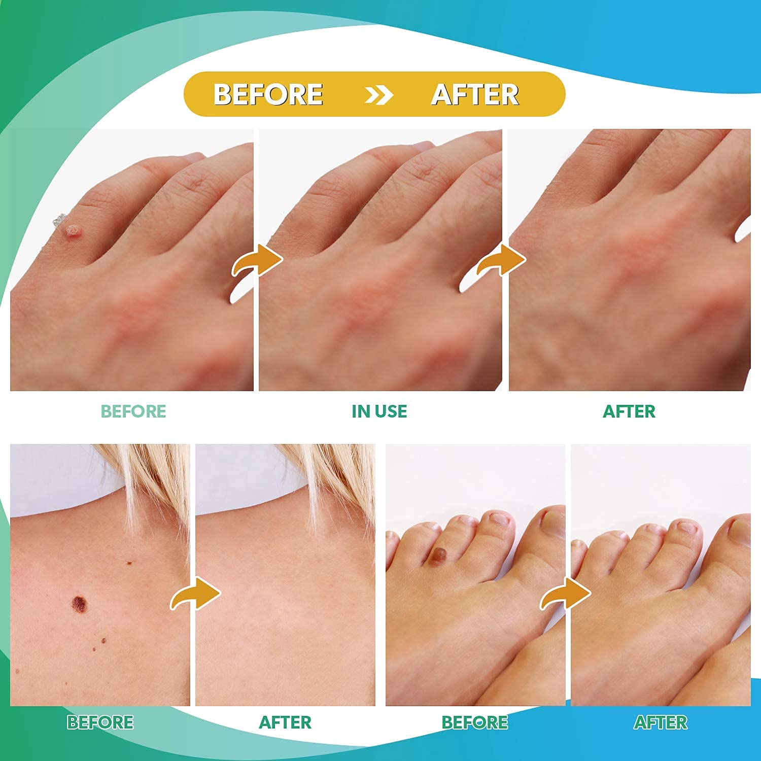 Bambosa Skin Tag Remover Pads, Effective Skin Tags Removal Treatment, Skin Tag Remover, Safe and Fas