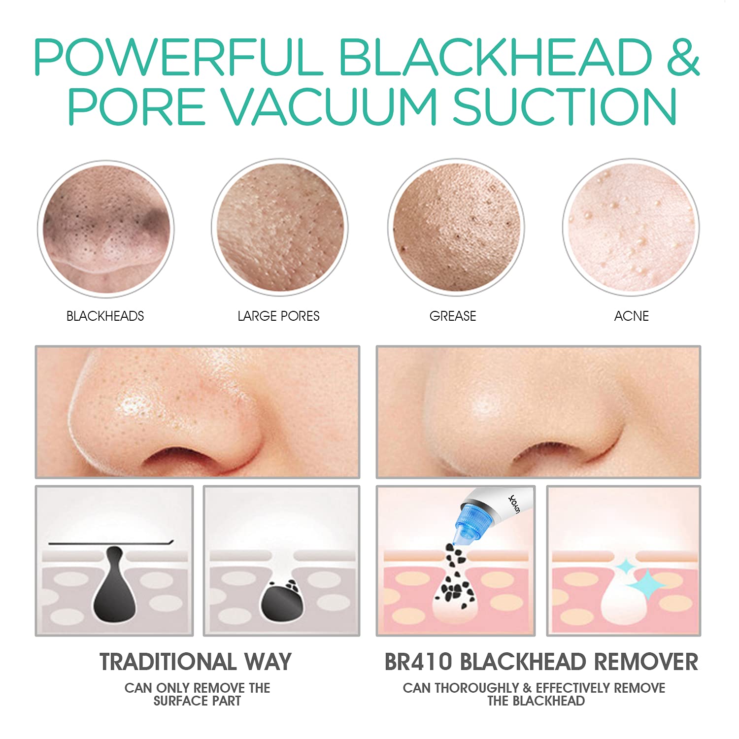 VOYOR Blackhead Remover Pore Vacuum - Electric Face Vacuum Pore Cleaner Acne White Heads Removal wit