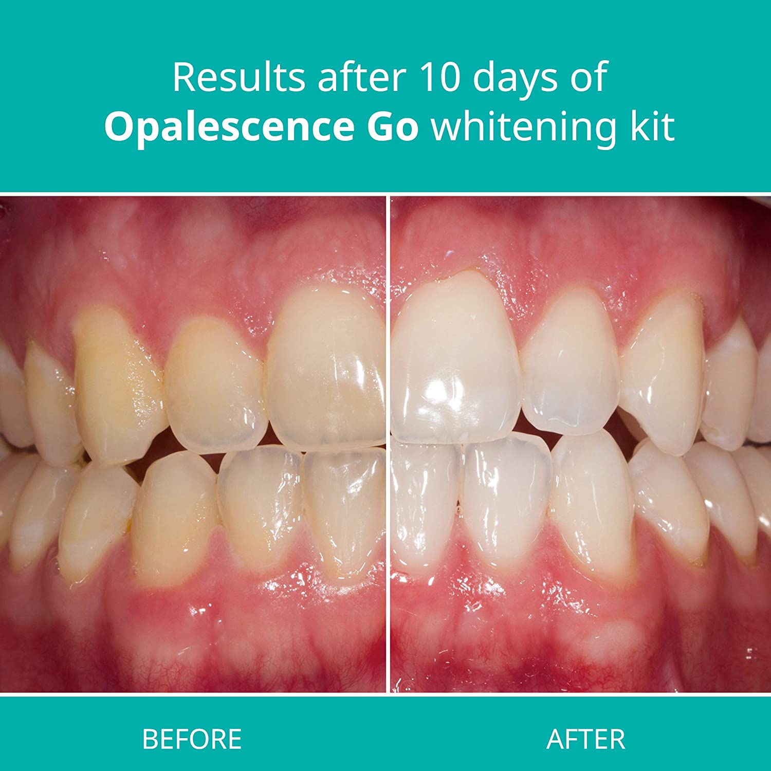 Opalescence Go - Prefilled Teeth Whitening Trays - 10% Hydrogen Peroxide - Mint