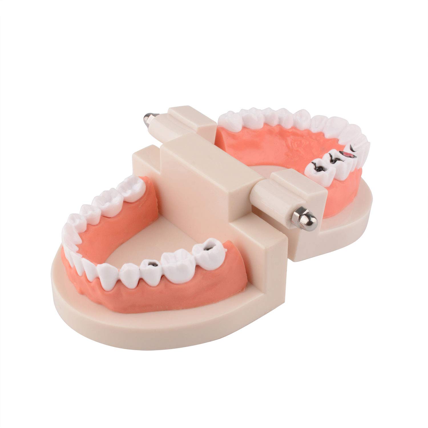 Ultrassist Dental Caries Study Model, 1:1 Life Size Fake Adult Dental Tooth Decay Model, Dental Hygi