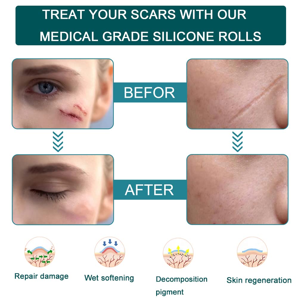 Silicone Scar Sheets, 1.6”x 120” Long Tape Roll, Reusable, Medical Grade Silicone Scar Removal S