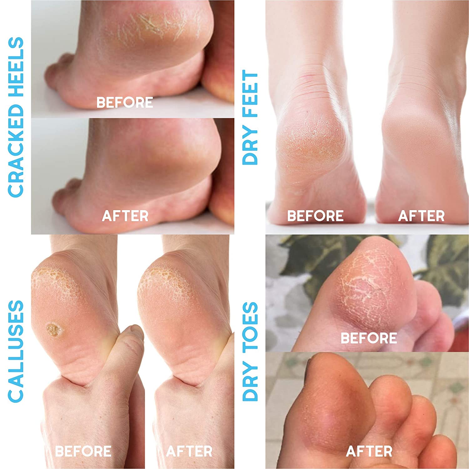 Tea Tree Oil Foot Balm, 100% All Natural Moisturizing Fast Acting Cream For Dry Feet & Cracked Heels