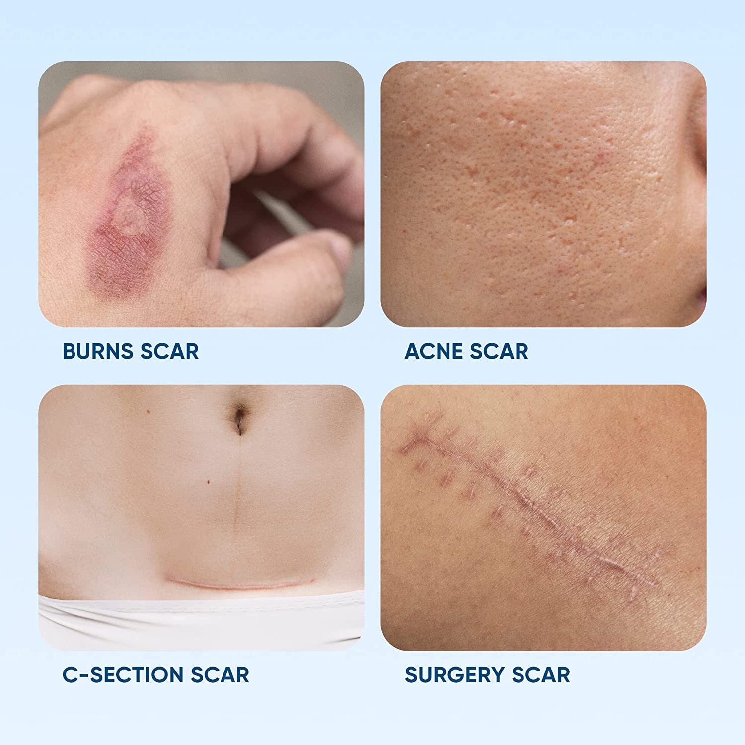 Silicone Scar Removal Sheets - Breathable Reusable & Waterproof Keloid Scar Removal Patches Caused b
