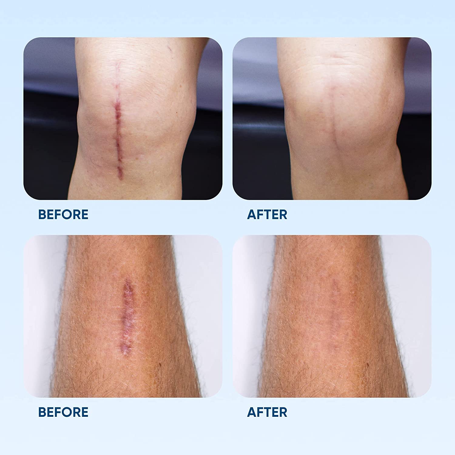 Silicone Scar Removal Sheets - Breathable Reusable & Waterproof Keloid Scar Removal Patches Caused b