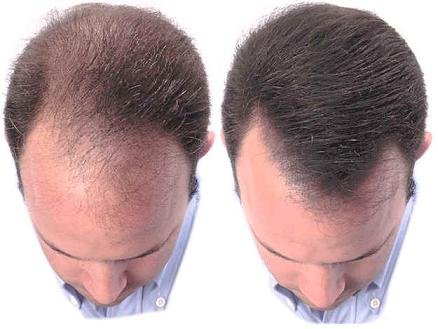 BIO WOMAN Re Hair Tonic Extra For Chronic Hair Loss Size 100ml by