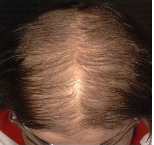 BIO WOMAN Re Hair Tonic Extra For Chronic Hair Loss Size 100ml by