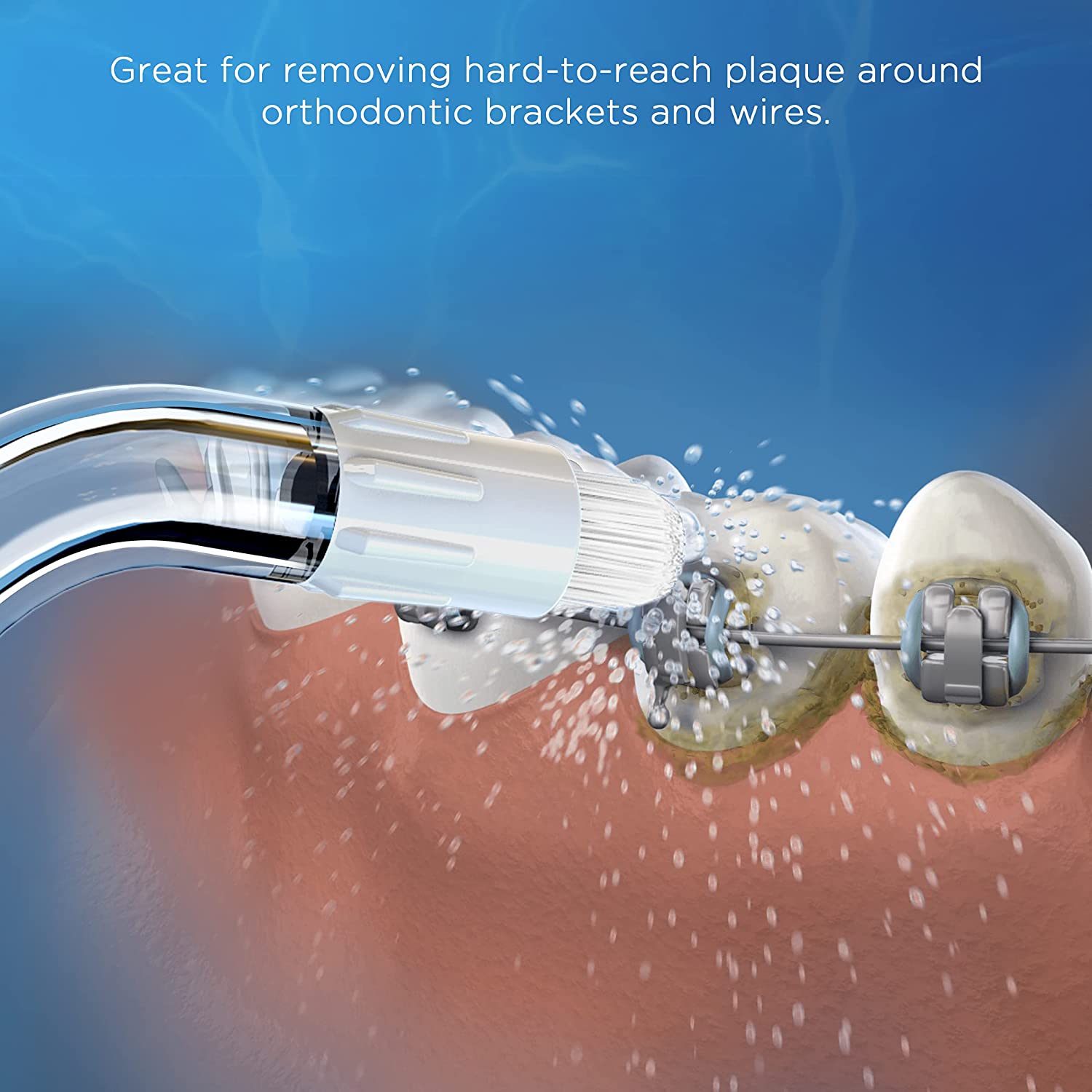 Replacement Tips for Waterpik Water Flosser (6 Orthodontic Tips & Storage Case Bundle)