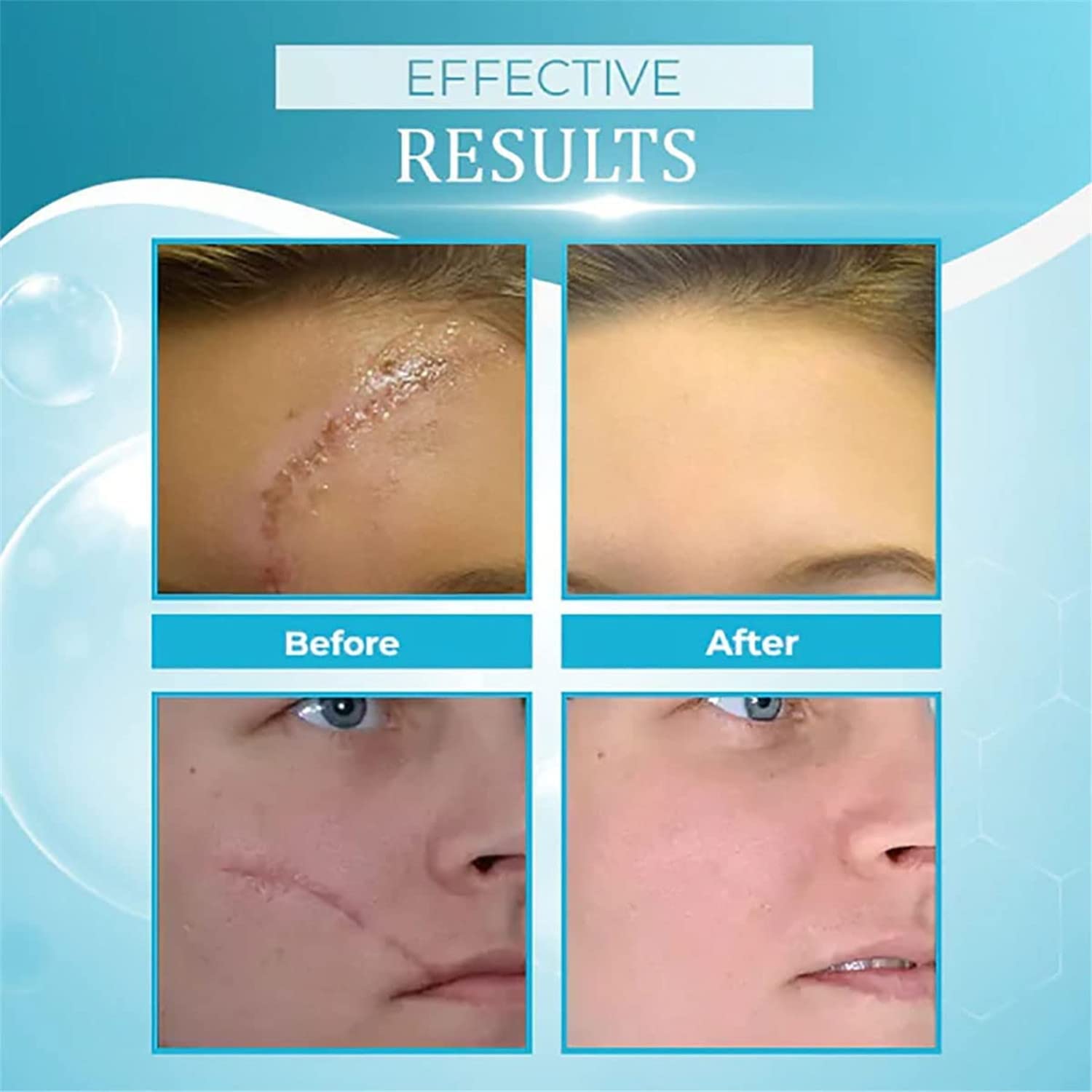 Organic Scar Removing Gel, Scar Removal Cream for Old Scars, Scar Repair Gel Cream for Man and Women