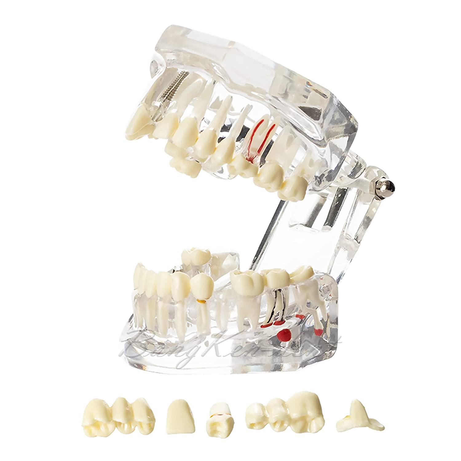 Dental Teeth Model Implant Model Teach Study Demo Tooth Analysis Demonstration Teeth Restoration 200