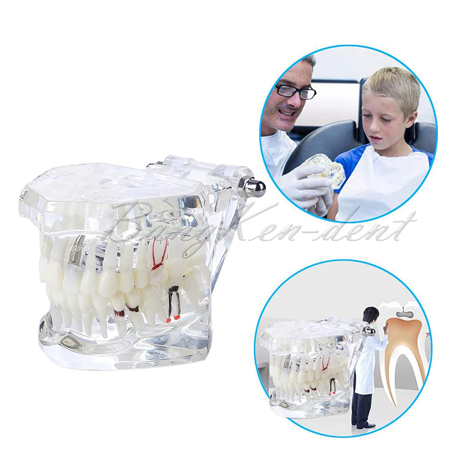 Dental Teeth Model Implant Model Teach Study Demo Tooth Analysis Demonstration Teeth Restoration 200