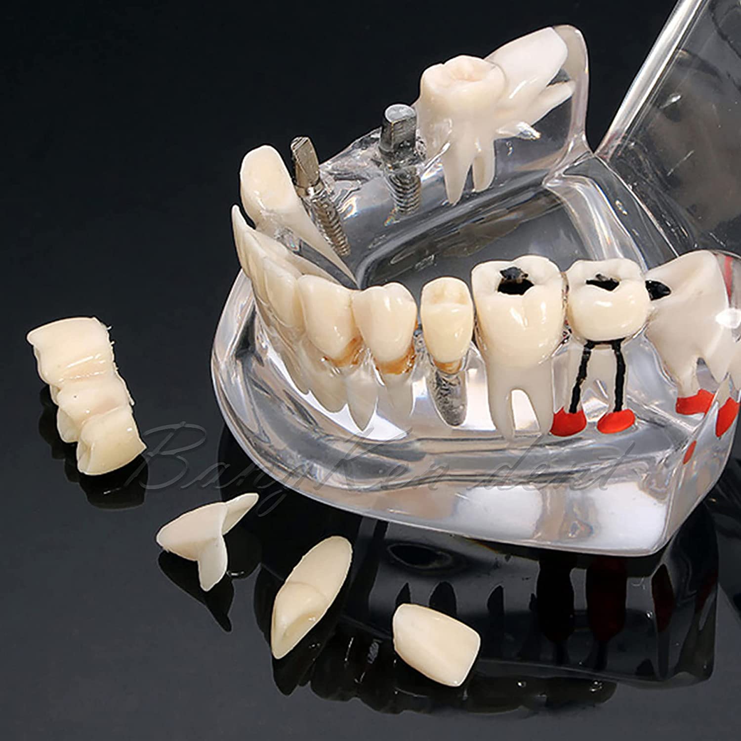 Dental Teeth Model Implant Model Teach Study Demo Tooth Analysis Demonstration Teeth Restoration 200