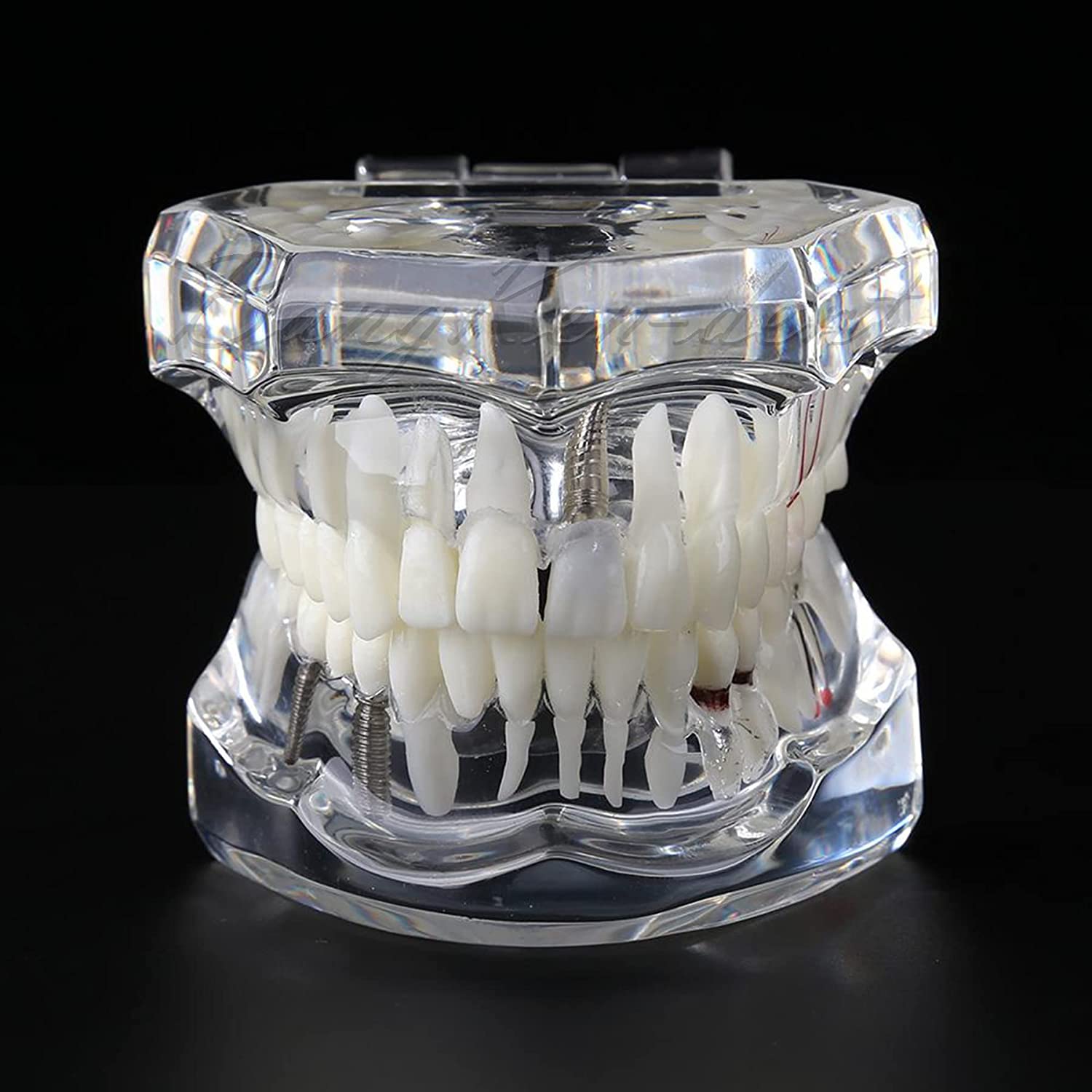 Dental Teeth Model Implant Model Teach Study Demo Tooth Analysis Demonstration Teeth Restoration 200
