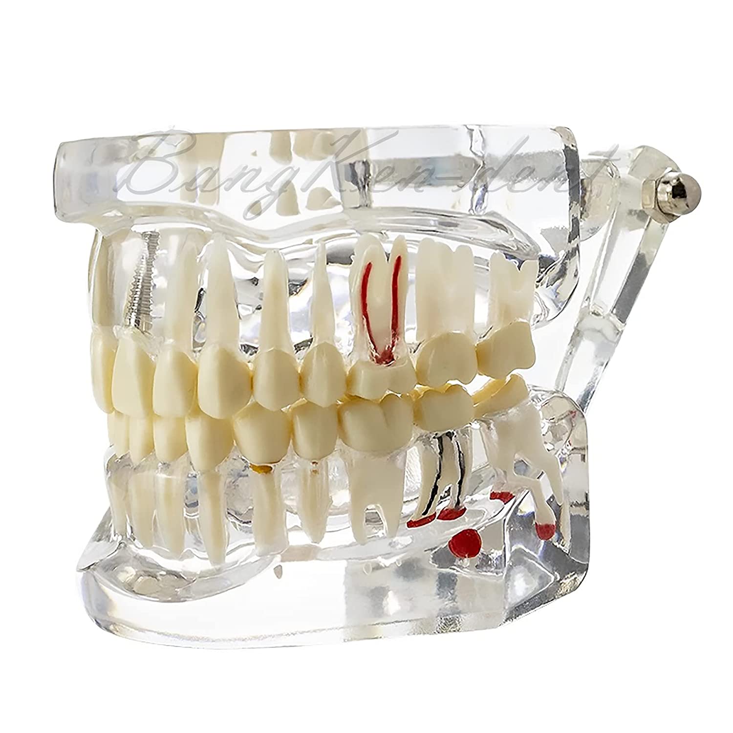 Dental Teeth Model Implant Model Teach Study Demo Tooth Analysis Demonstration Teeth Restoration 200