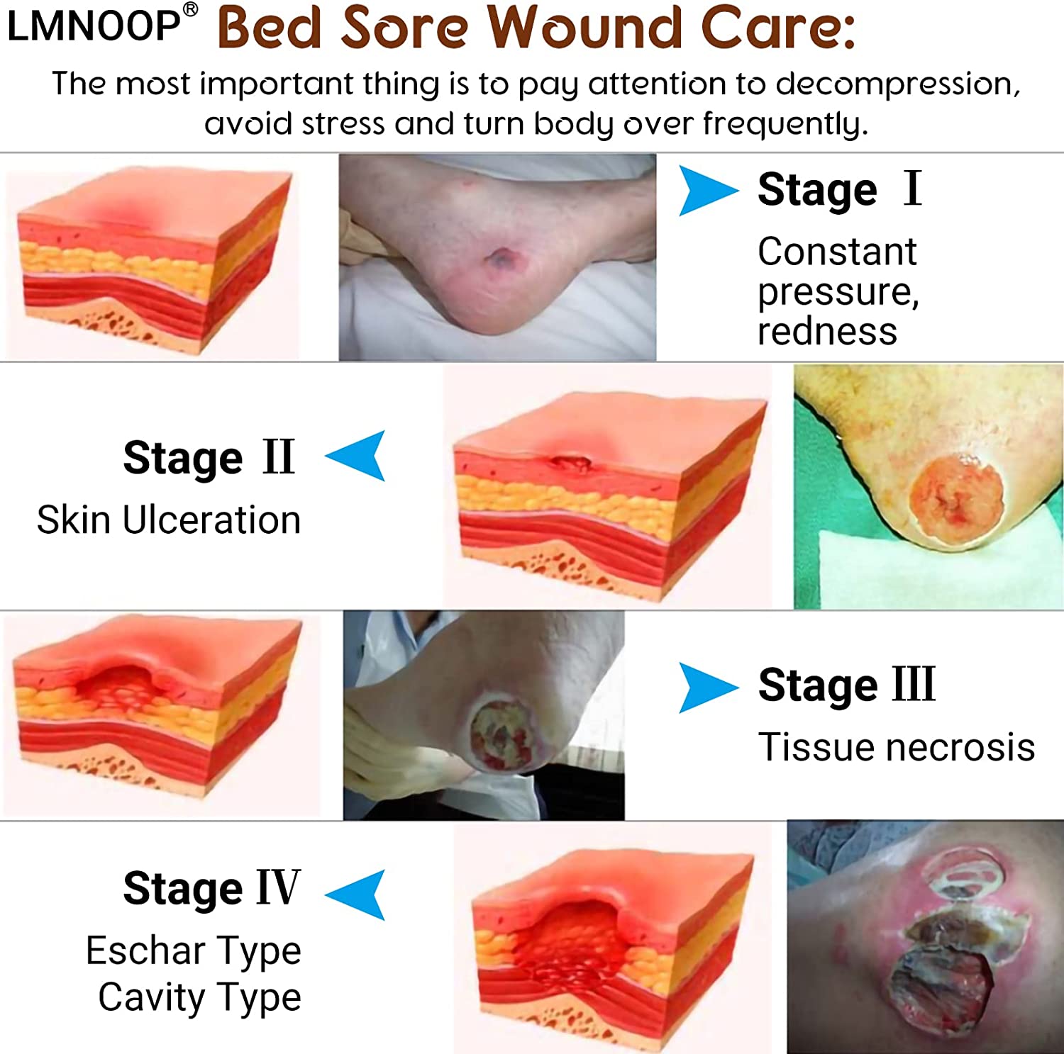 LMNOOP® Bed Sore Cream, Maximum Strength Wound Care Ointment for