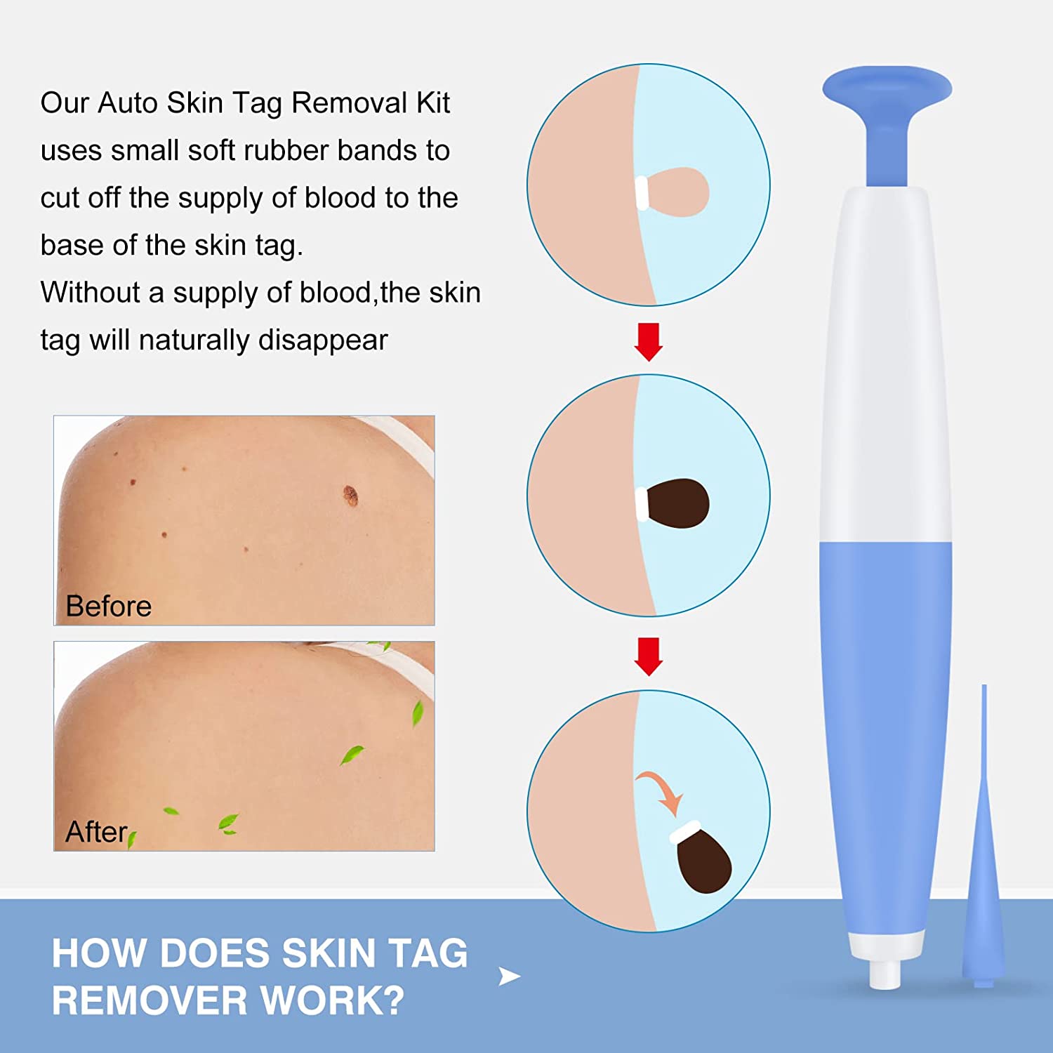 Skin Tag Remover, Skin Tag Removal Kit Device for Small to Medium (2mm