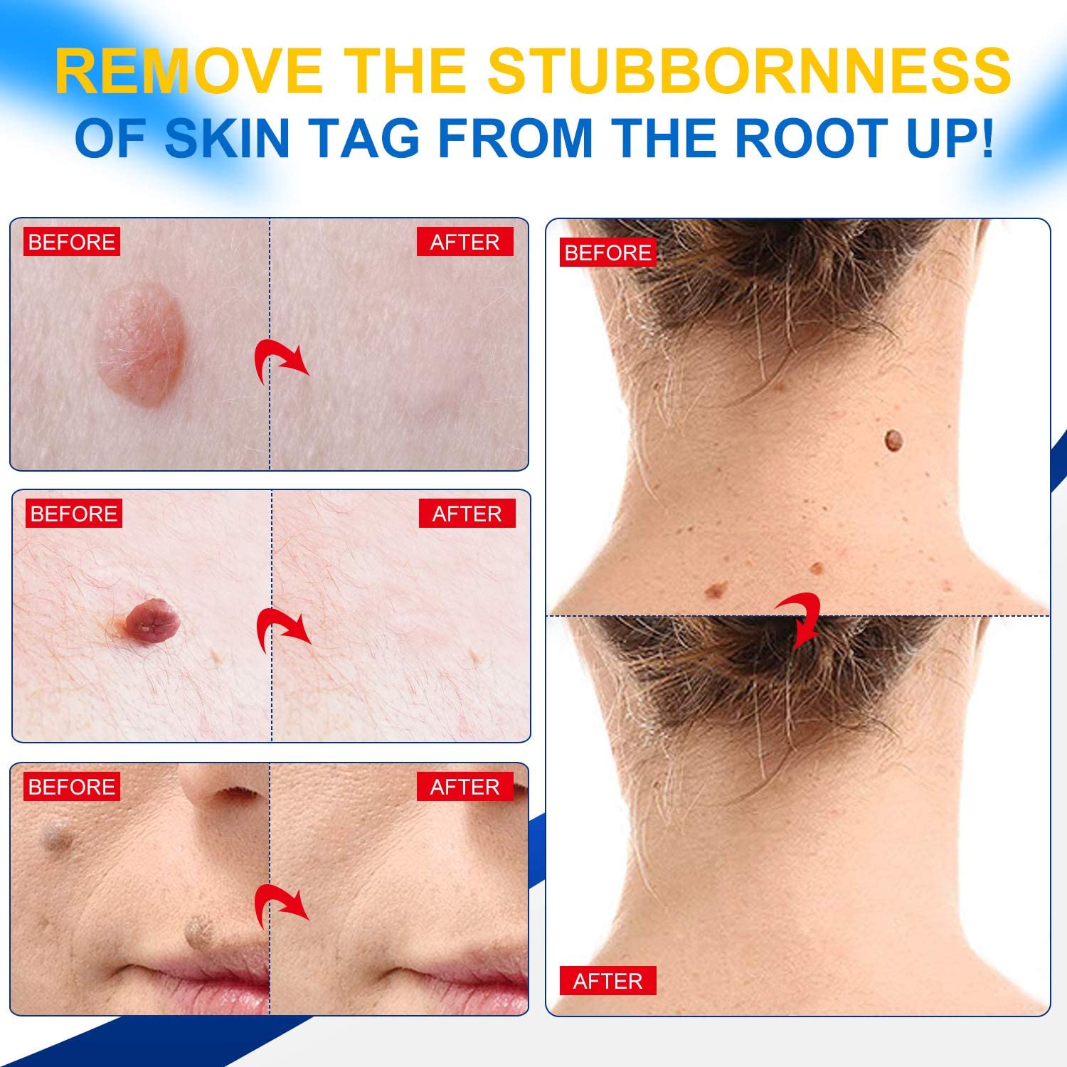 Wart Remover Cream,Skin Tag and Common Warts Treatment,Callus Painlessly, Effective and Safe