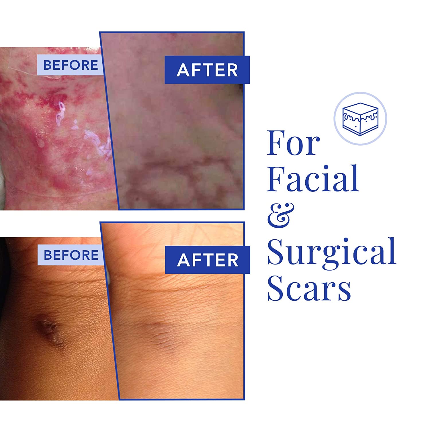 Rejuvaskin Scar Heal Kit for Breast Procedures Breast Lollipop Pair