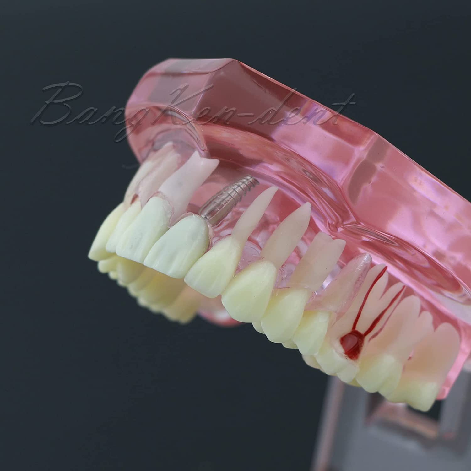 Dental Teeth Model Implant Typodont Model Teach Study Demo Tooth Analysis Demonstration Teeth Restor