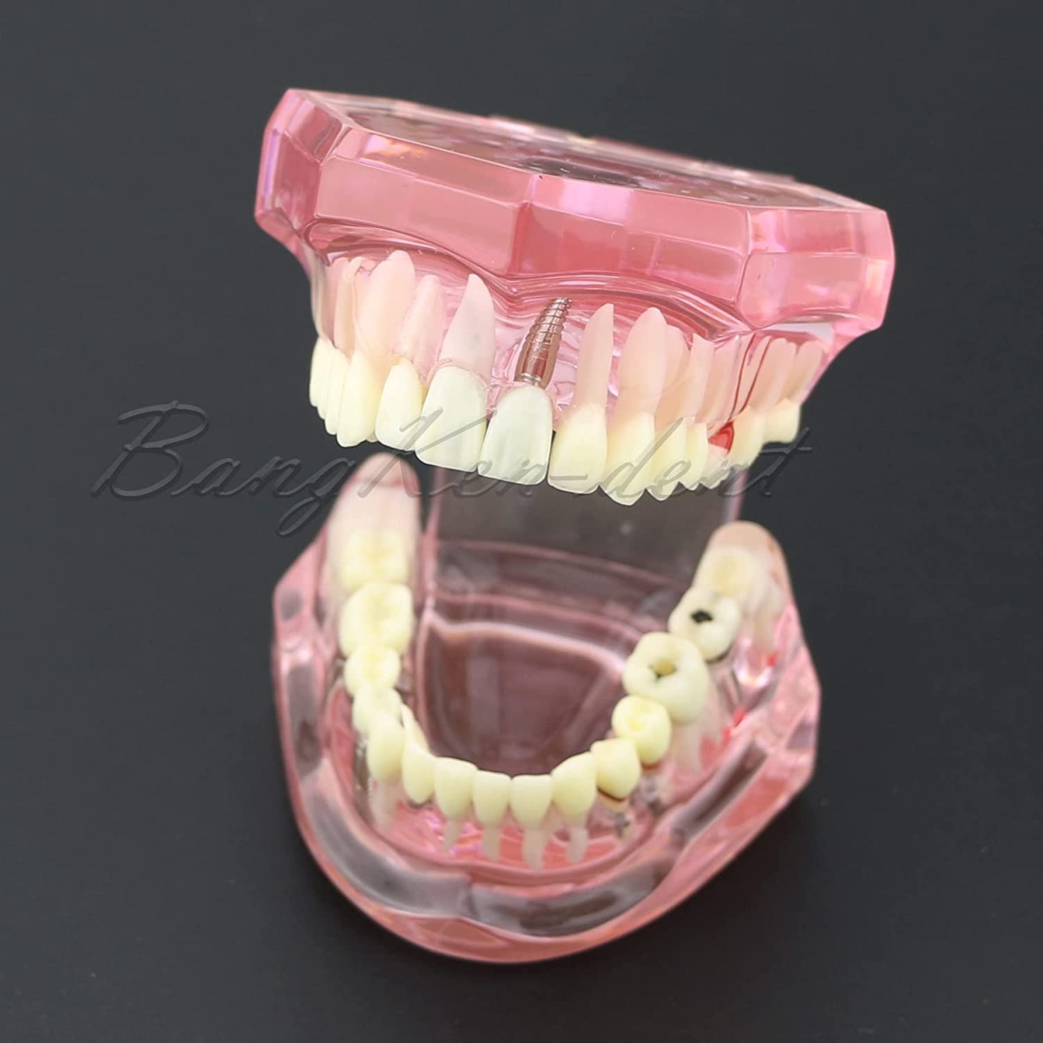Dental Teeth Model Implant Typodont Model Teach Study Demo Tooth Analysis Demonstration Teeth Restor