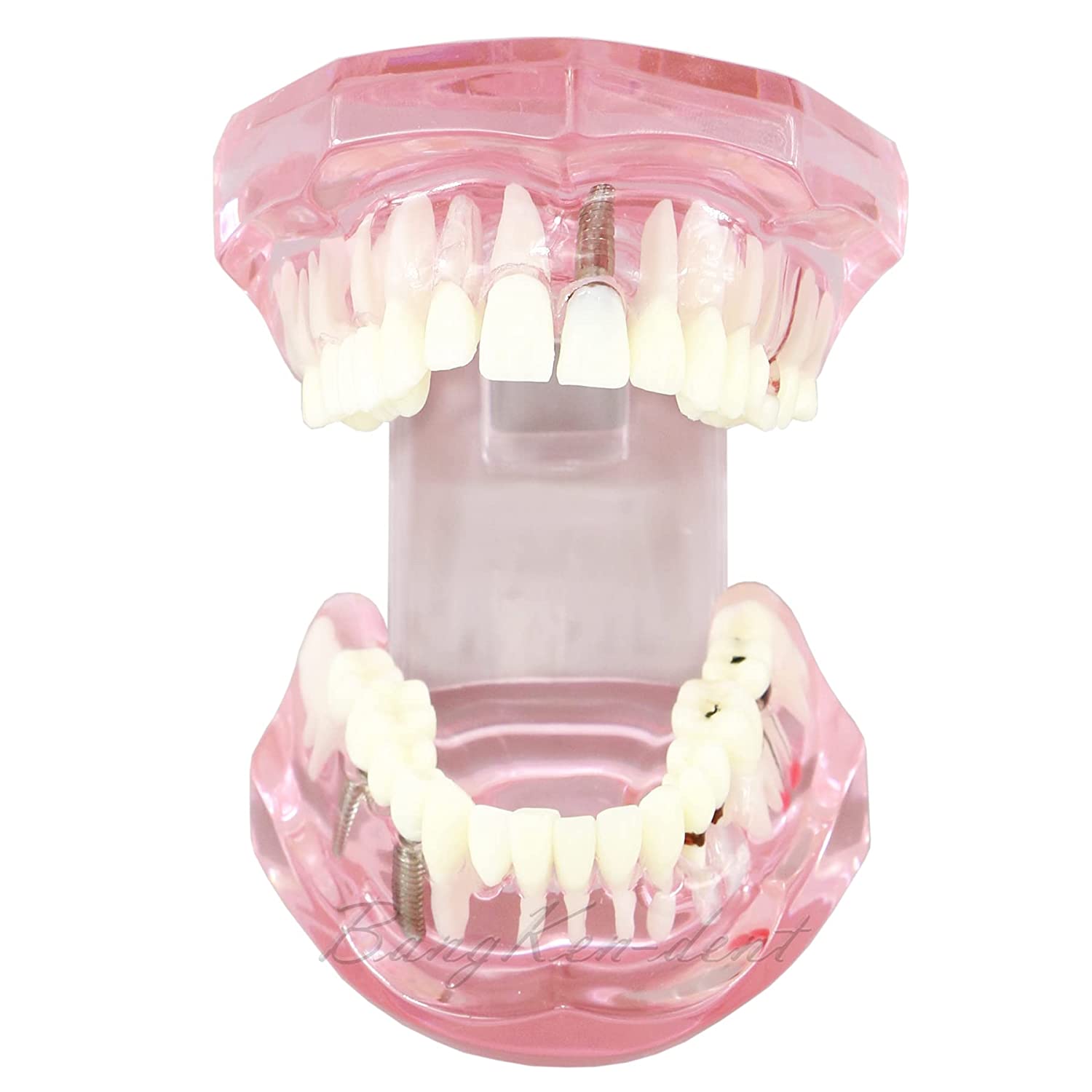 Dental Teeth Model Implant Typodont Model Teach Study Demo Tooth Analysis Demonstration Teeth Restor