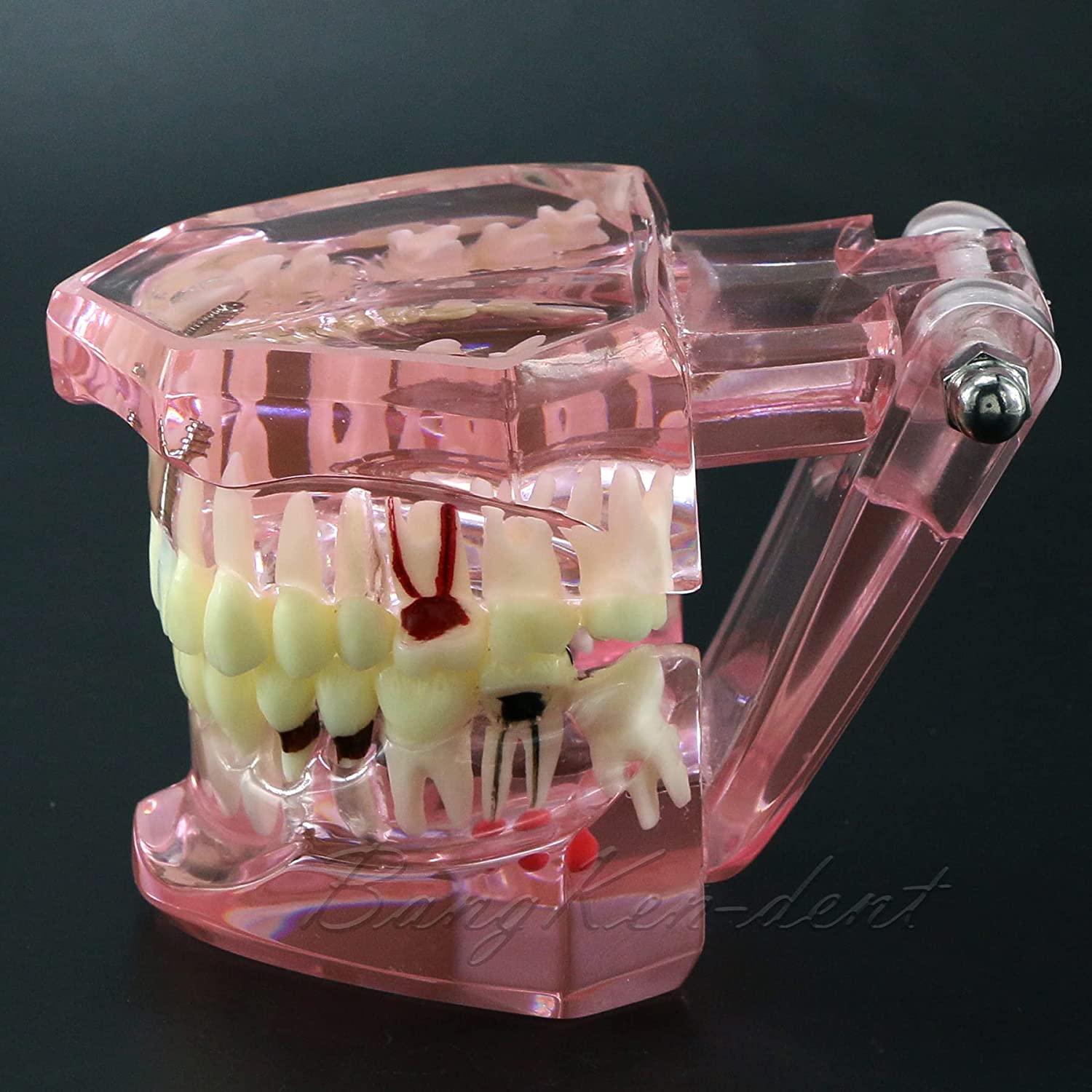 Dental Teeth Model Implant Typodont Model Teach Study Demo Tooth Analysis Demonstration Teeth Restor