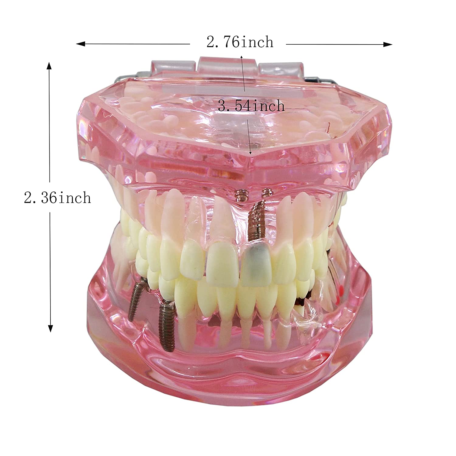 Dental Teeth Model Implant Typodont Model Teach Study Demo Tooth Analysis Demonstration Teeth Restor