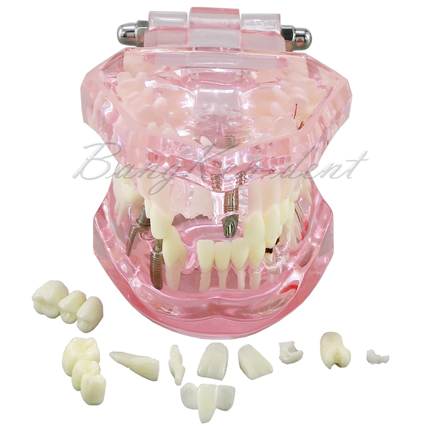 Dental Teeth Model Implant Typodont Model Teach Study Demo Tooth Analysis Demonstration Teeth Restor