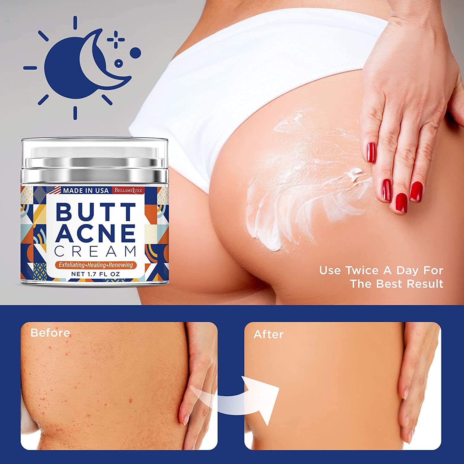 Butt Acne Clearing Cream, Thigh Acne Clearing treatment, Made in USA, Clears Acne, Pimples, and Dark