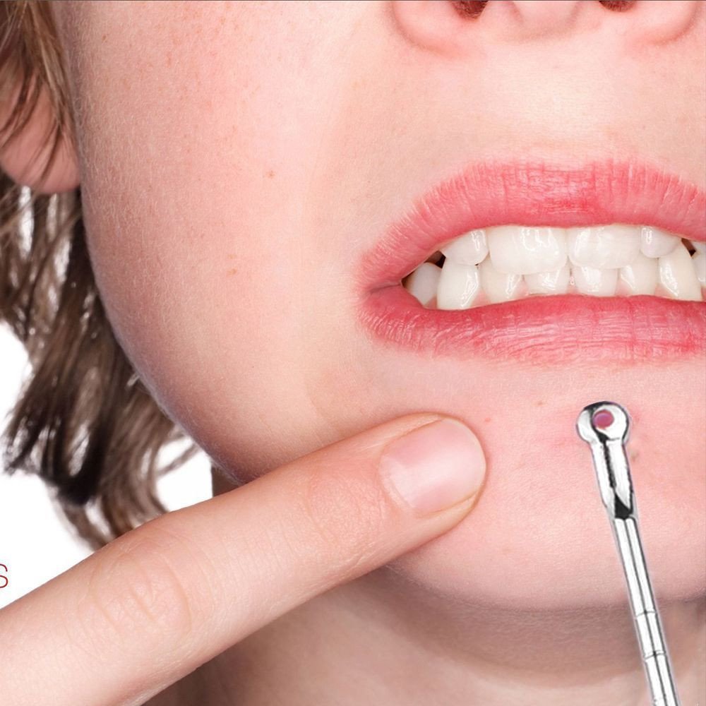Stainless Facial Acne Spot Pimple Remover Extractor Tool Comedone,Pimple Blemish Comedone Acne Extra