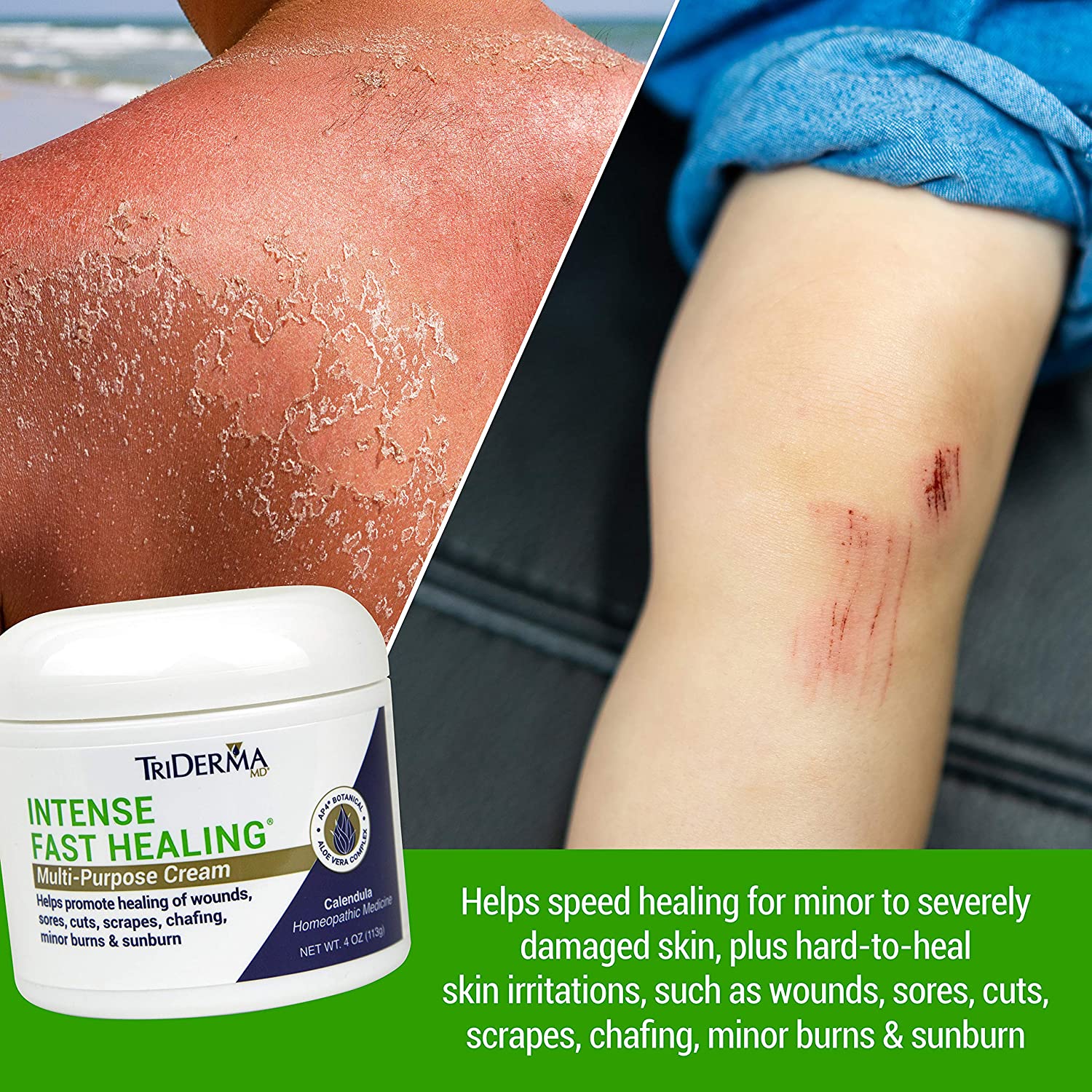 TriDerma Intense Fast Healing Cream, Decreases Healing Time for Minor Irritations, Rashes