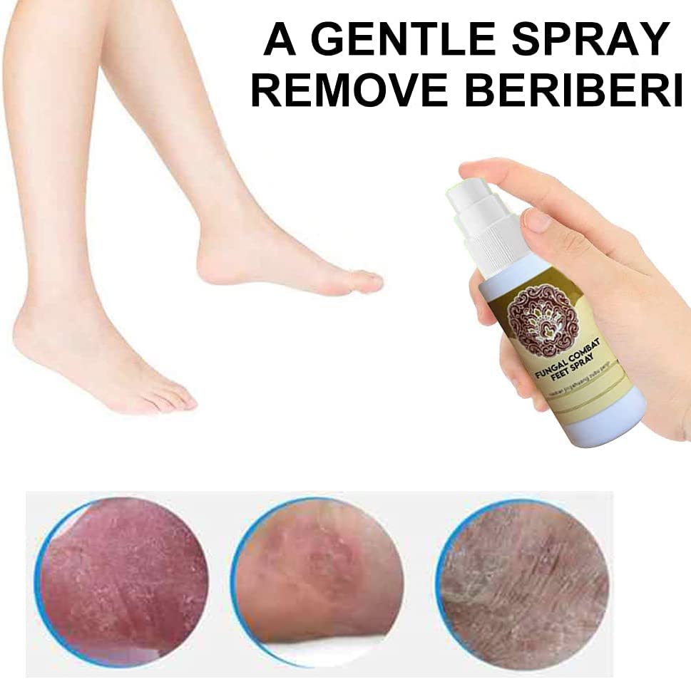 Fungal Combat Feet Spray, 60ml Anti Fungal Infections Athlete