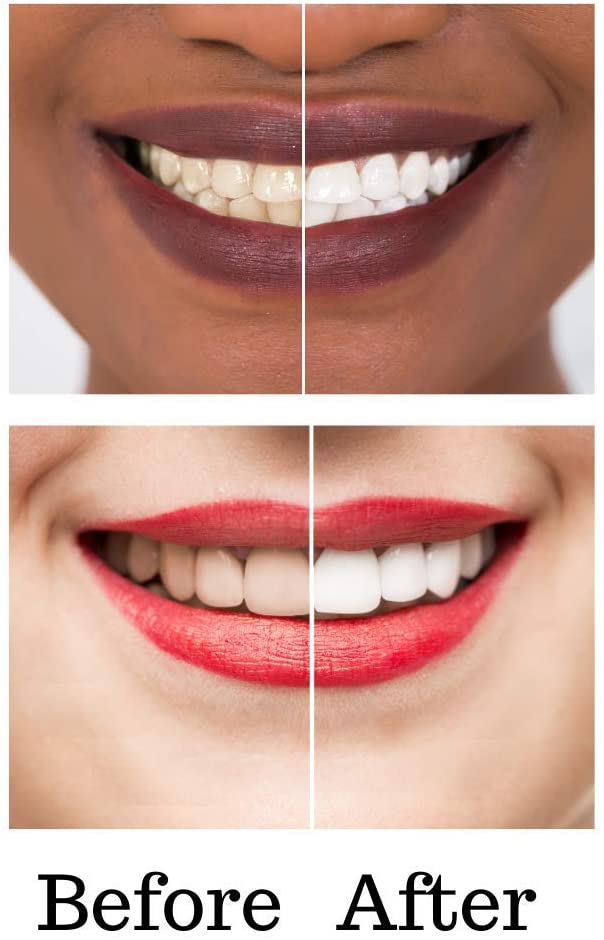 Deluxe Teeth Whitening Two 4ml Pens Kit with Carbamide Peroxide Tooth whitening Gel Made in USA (35%