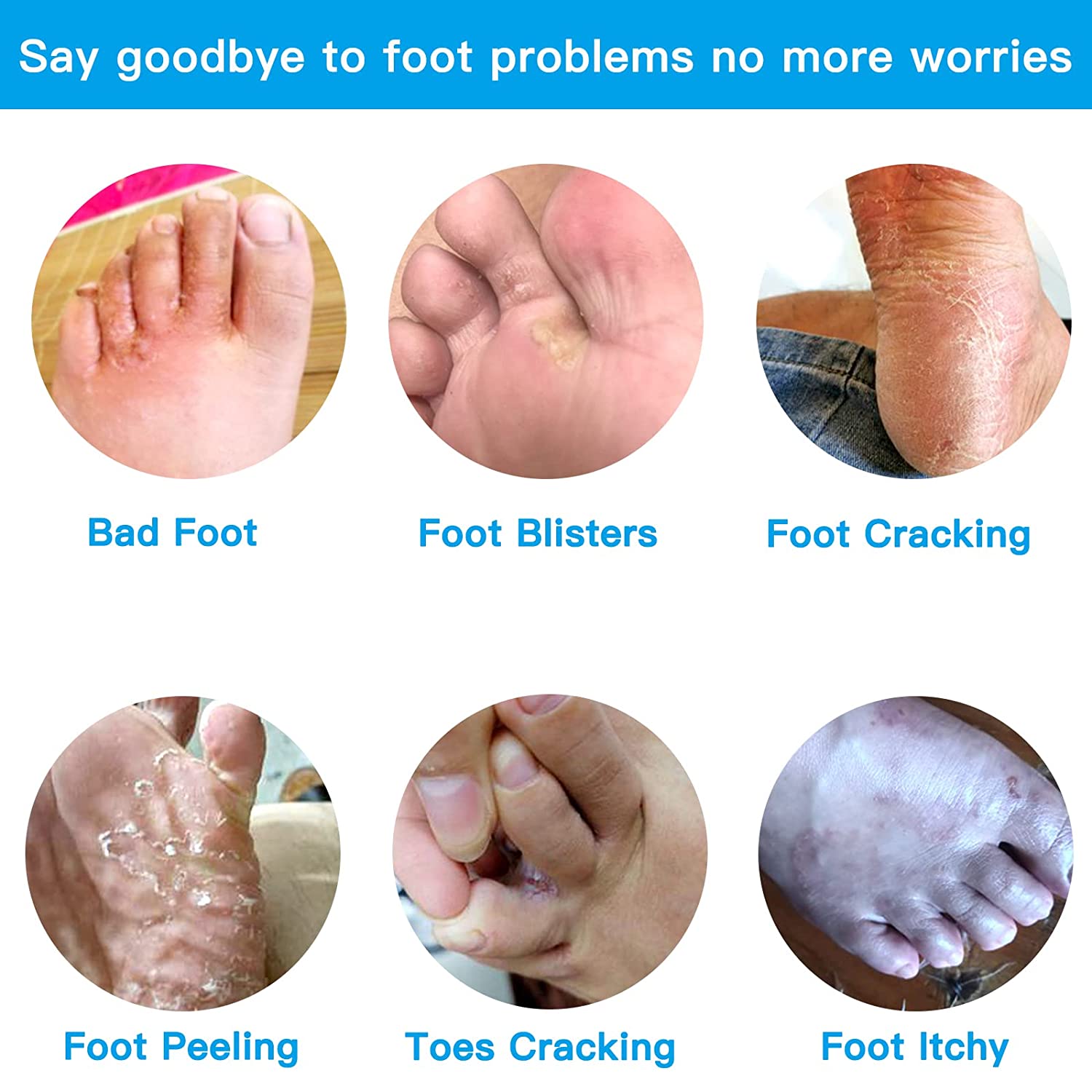 Lanmayee Foot Fungi Spray+Daub,Athletes Foot Treatment Kit.Most Athletes Foot Between Toes.Foot Itch