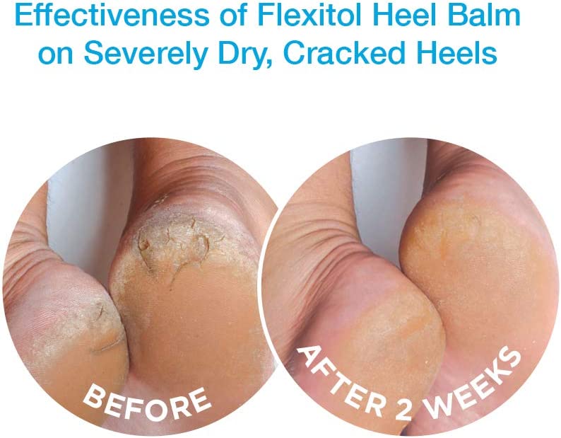 Flexitol Heel Balm 4 Oz Tube (Pack of 2), Rich Moisturizing & Exfoliating Foot Cream. Fast Relief of